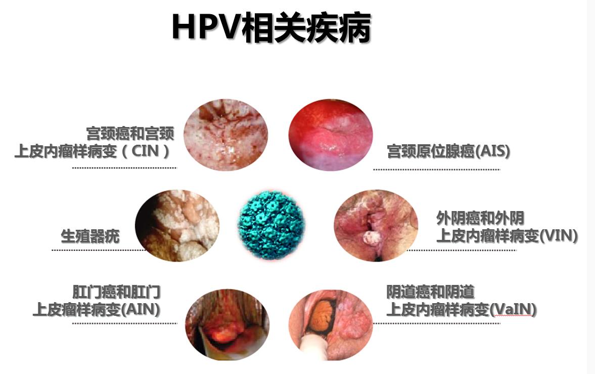 最新宫颈癌，爱与奇迹的交织篇章